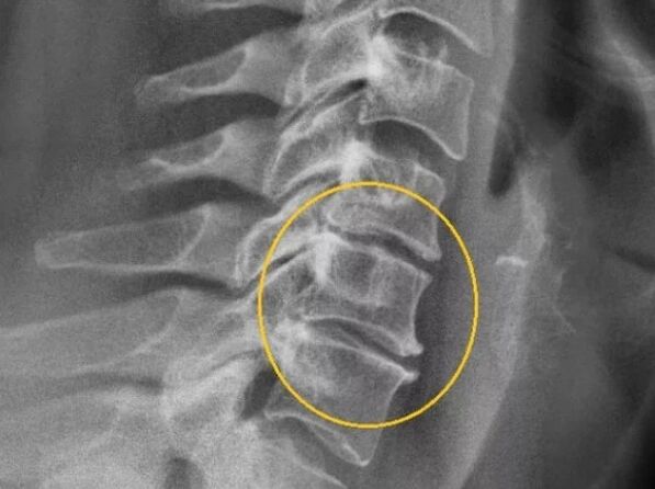 Osteochondróza krčnej chrbtice na x -roy