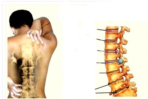 Osteochondróza je príčinou bolesti chrbta