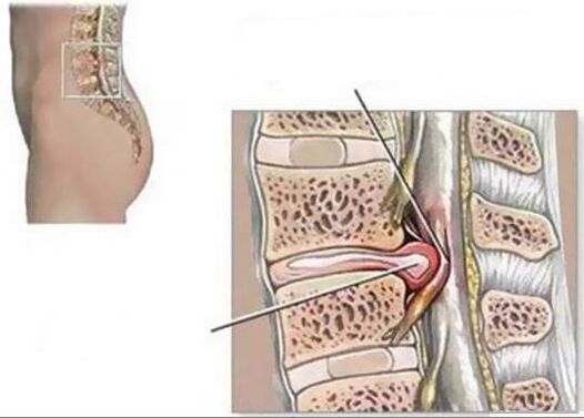 medziskupina Hernia spôsobuje bolesť chrbta